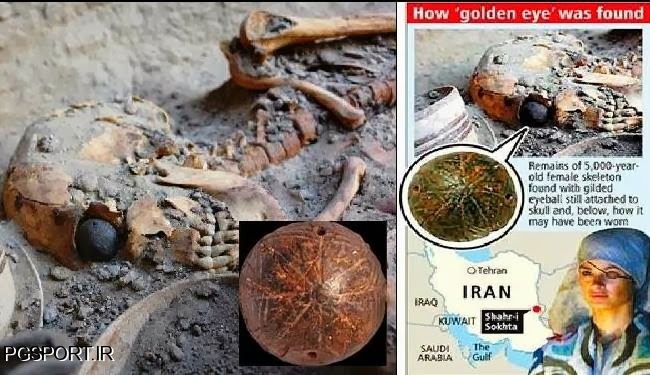  اولین چشم مصنوعی جهان با قدمت 4500 سال در ایران!!